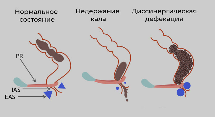 энкопрез